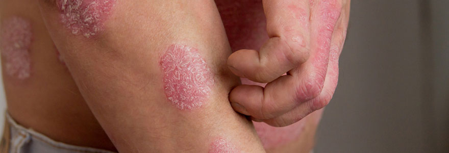 Solutions naturelles pour traiter le psoriasis